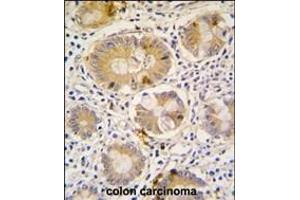 Formalin-fixed and paraffin-embedded human colon carcinoma tissue reacted with Autophagy G16L antibody (C-term), which was peroxidase-conjugated to the secondary antibody, followed by DAB staining.