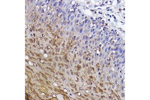 Immunohistochemistry of paraffin-embedded human cervical using SSC/SerpinB3 Rabbit mAb (ABIN7270242) at dilution of 1:100 (40x lens). (SERPINB3 antibody)