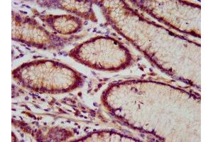 IHC image of ABIN7151176 diluted at 1:800 and staining in paraffin-embedded human gastric cancer performed on a Leica BondTM system. (RNF213 antibody  (AA 202-350))