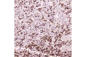 IHC testing of FFPE human gastric cancer with Cathepsin E antibody at 2ug/ml. (Cathepsin E antibody  (AA 150-393))