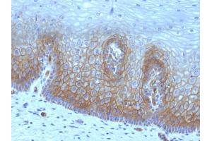 Formalin-fixed, paraffin-embedded human Cervical Carcinoma stained with Thrombomodulin / CD141 Monoclonal Antibody (rTHBD/1591). (Recombinant Thrombomodulin antibody  (AA 69-194))