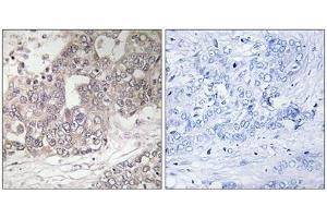 Immunohistochemistry analysis of paraffin-embedded human liver carcinoma tissue using ATG4C antibody. (ATG4C antibody  (N-Term))