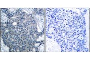 Immunohistochemistry analysis of paraffin-embedded human breast carcinoma tissue, using Stathmin 1 (Ab-24) Antibody. (Stathmin 1 antibody  (AA 9-58))