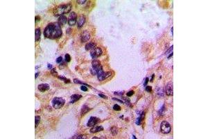 Immunohistochemical analysis of PABPC5 staining in human lung cancer formalin fixed paraffin embedded tissue section. (PABPC5 antibody)