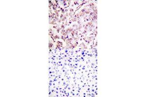 Immunohistochemical staining (Formalin-fixed paraffin-embedded sections) of human breast cancer tissue with ETS1 (phospho T38) polyclonal antibody  without blocking peptide (A) or preincubated with blocking peptide (B) under 1:50-1:100 dilution. (ETS1 antibody  (pThr38))