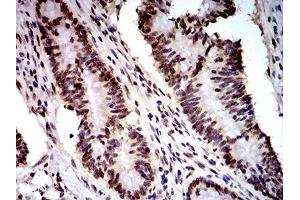 Immunohistochemical analysis of paraffin-embedded colon cancer tissues using DDX1 mouse mAb with DAB staining. (DDX1 antibody  (AA 642-740))