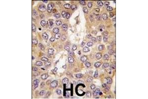 Formalin-fixed and paraffin-embedded human hepatocarcinoma tissue reacted with CK1g2 antibody (C-term), which was peroxidase-conjugated to the secondary antibody, followed by DAB staining. (Casein Kinase 1 gamma 2 antibody  (C-Term))