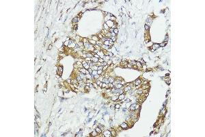 Immunohistochemistry of paraffin-embedded human lung cancer using SOCS6 antibody (ABIN6128785, ABIN6148273, ABIN6148274 and ABIN6225294) at dilution of 1:100 (40x lens). (SOCS6 antibody  (AA 1-210))