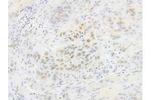 ABIN6260348 and ABIN6269272 at 1/100 staining human tongue carcinoma by IHC-P.