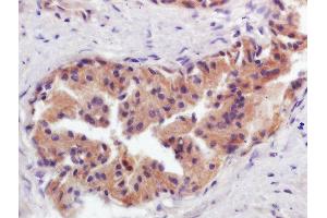 Formalin-fixed and paraffin embedded human prostate labeled with Anti-GCNT2 Polyclonal Antibody, Unconjugated  at 1:200 followed by conjugation to the secondary antibody and DAB staining (GCNT2 antibody  (AA 151-250))