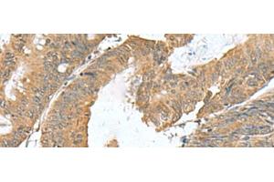 Immunohistochemistry of paraffin-embedded Human colorectal cancer tissue using RAB23 Polyclonal Antibody at dilution of 1:50(x200) (RAB23 antibody)