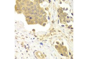 Immunohistochemistry of paraffin-embedded Human mammary cancer using GABARAP antibody at dilution of 1:100 (x400 lens). (GABARAP antibody)