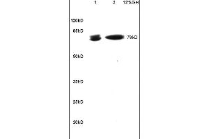 Formalin-fixed and paraffin embedded human gastric carcinoma labeled with Rabbit Anti BCL-6/5 Polyclonal Antibody, Unconjugated (ABIN749843) at 1:200 followed by conjugation to the secondary antibody and DAB staining (BCL6 antibody  (AA 501-600))