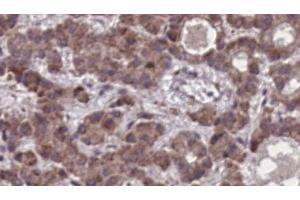 ABIN6273908 at 1/100 staining Human liver cancer tissue by IHC-P.