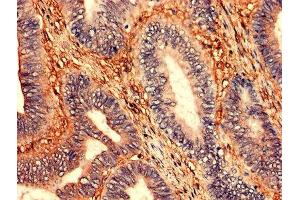 Immunohistochemistry analysis of human colon cancer using ABIN7176531 at dilution of 1:100 (ZNF791 antibody  (AA 1-250))
