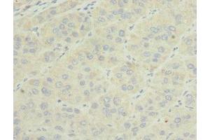 Immunohistochemistry of paraffin-embedded human liver cancer using ABIN7159816 at dilution of 1:100 (OGN antibody  (AA 20-298))