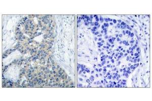 Immunohistochemical analysis of paraffin-embedded human breast carcinoma tissue using Stathmin 1(Phospho-Ser38) Antibody(left) or the same antibody preincubated with blocking peptide(right). (Stathmin 1 antibody  (pSer38))