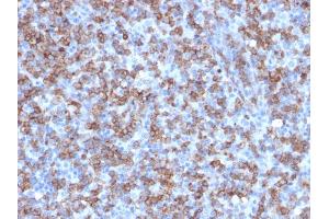 Formalin-fixed, paraffin-embedded human Lymphoma stained with CD8a Rabbit Recombinant Monoclonal Antibody (C8/1779R). (Recombinant CD8 alpha antibody)
