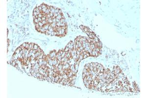 Formalin-fixed, paraffin-embedded human breast carcinoma stained with Calprotectin Mouse Monoclonal Antibody (S100A9/1075). (S100A9 antibody)