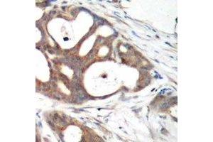 Immunohistochemical analysis of Estrogen Receptor alpha staining in human breast cancer formalin fixed paraffin embedded tissue section. (Estrogen Receptor alpha antibody)