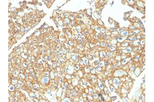 Formalin-fixed, paraffin-embedded human Renal Cell Carcinoma stained with EpCAM Rabbit Polyclonal Antibody. (EpCAM antibody)