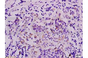 Formalin-fixed and paraffin embedded human colon carcinoma labeled with Anti-GPR49/LGR5 Polyclonal Antibody, Unconjugated (ABIN737916) at 1:200 followed by conjugation to the secondary antibody and DAB staining. (LGR5 antibody  (AA 810-907))