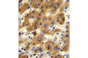 Formalin-fixed and paraffin-embedded human hepatocarcinoma reacted with CYP8B1 Antibody , which was peroxidase-conjugated to the secondary antibody, followed by DAB staining. (CYP8B1 antibody  (C-Term))