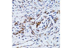 Immunohistochemistry of paraffin-embedded human uterine cancer using RARS antibody (ABIN5973728) at dilution of 1/100 (40x lens). (RARS antibody)