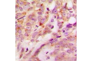 Immunohistochemical analysis of Laminin alpha 4 staining in human breast cancer formalin fixed paraffin embedded tissue section. (LAMa4 antibody  (Center))