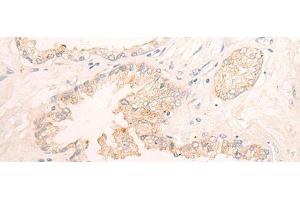 Immunohistochemistry of paraffin-embedded Human prost ate cancer tissue using ELANE Polyclonal Antibody at dilution of 1:25(x200) (ELANE antibody)