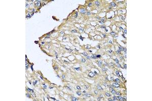 Immunohistochemistry of paraffin-embedded human prostate cancer using ASIP antibody (ABIN5974140) at dilution of 1/100 (40x lens). (ASIP antibody)