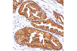 Formalin/paraffin human prostate carcinoma stained with ODC-1 antibody. (ODC1 antibody)