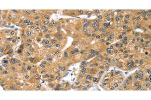 Immunohistochemistry of paraffin-embedded Human liver cancer using PRSS50 Polyclonal Antibody at dilution of 1:30 (PRSS50 antibody)
