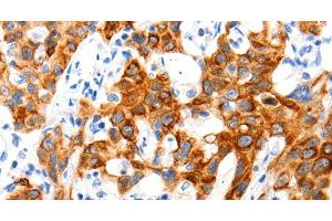 Immunohistochemistry of paraffin-embedded Human lung cancer tissue using SLC2A11 Polyclonal Antibody at dilution 1:140