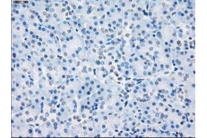 Immunohistochemical staining of paraffin-embedded Adenocarcinoma of colon tissue using anti-LTA4Hmouse monoclonal antibody. (LTA4H antibody)