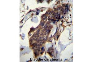 CCDC13 Antibody (N-term) immunohistochemistry analysis in formalin fixed and paraffin embedded human bladder carcinoma followed by peroxidase conjugation of the secondary antibody and DAB staining. (CCDC13 antibody  (N-Term))