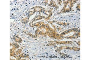 Immunohistochemistry of Human colon cancer using ASB8 Polyclonal Antibody at dilution of 1:50 (ASB8 antibody)