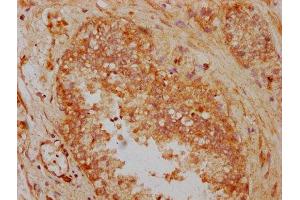 IHC image of ABIN7165406 diluted at 1:300 and staining in paraffin-embedded human prostate cancer performed on a Leica BondTM system. (FAM13A antibody  (AA 1-201))