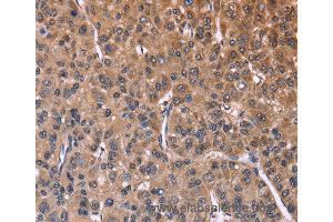 Immunohistochemistry of Human liver cancer using SEPT7 Polyclonal Antibody at dilution of 1:60 (Septin 7 antibody)