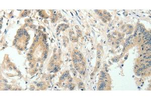 Immunohistochemistry of paraffin-embedded Human colon cancer using SIRT3 Polyclonal Antibody at dilution of 1:30 (SIRT3 antibody)