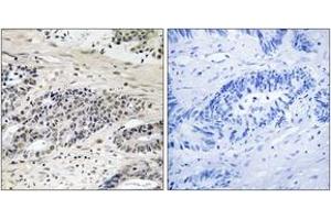 Immunohistochemistry analysis of paraffin-embedded human colon carcinoma, using AurA (Phospho-Ser342) Antibody. (AurA (AA 311-360), (pSer342) antibody)