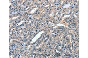Immunohistochemistry of Human colon cancer using ANGPT1 Polyclonal Antibody at dilution of 1:50