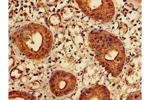 Immunohistochemistry of paraffin-embedded human colon cancer using ABIN7157550 at dilution of 1:100 (KIDINS220 antibody  (AA 1077-1370))