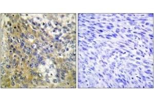 Immunohistochemistry analysis of paraffin-embedded human cervix carcinoma tissue, using Collagen IV alpha6 Antibody. (COL4a6 antibody  (AA 1201-1250))