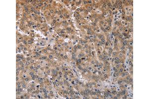 Immunohistochemistry of Human liver cancer using ECE1 Polyclonal Antibody at dilution of 1:50 (MAPRE3 antibody)