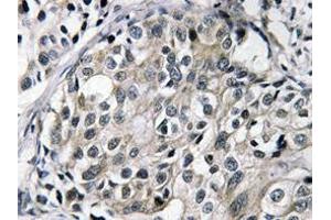 Immunohistochemistry (IHC) analyzes of TAT antibody in paraffin-embedded human breast carcinoma tissue. (HTATSF1 antibody)
