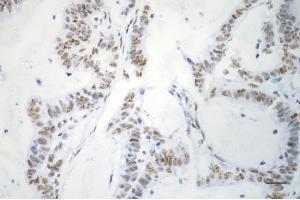 Immunohistochemistry was performed on paraffin-embedded human sigmoid colon carcinoma using phospho-p53 (S33) antibody (ABIN7800680), 1:200). (Recombinant p53 antibody  (pSer33))