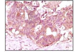 Immunohistochemical analysis of paraffin-embedded human recturn adenocarcinoma tissue showing cytoplasmic localization using FGF2 mouse mAb with DAB staining. (FGF2 antibody)