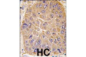 Formalin-fixed and paraffin-embedded human hepatocellular carcinoma reacted with ALDH5A1 polyclonal antibody  , which was peroxidase-conjugated to the secondary antibody, followed by DAB staining.