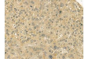 ABIN6258723 and ABIN6274903 at 1/100 staining human hepatocellular carcinoma by IHC-P.